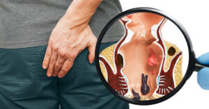 piles treatment at home